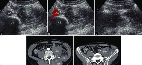 Left Traumatic Iliopsoas Hemorrhage In A 34 Year Old Man With Severe