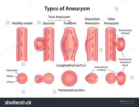 Aneurysm: Over 934 Royalty-Free Licensable Stock Vectors & Vector Art | Shutterstock