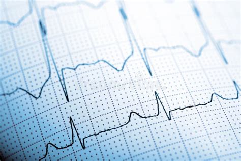 Electrocardiogramecg Printed On Graph Paper Stock Image Image Of