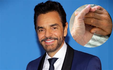 Eugenio Derbez Salió De Una Larga Y Complicada Cirugía Fama