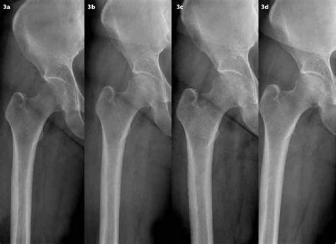 Case 2 Serial Anteroposterior Radiographs Of The Right Proximal Femur