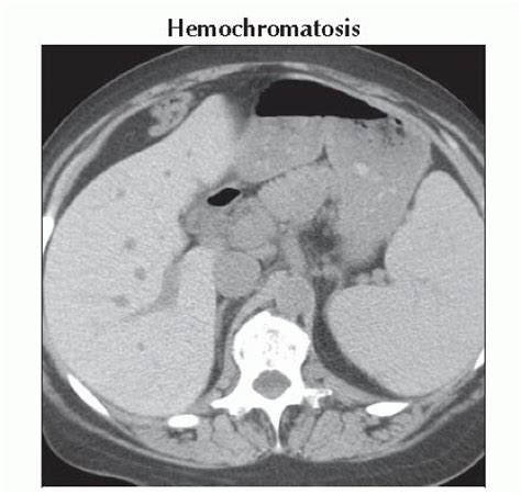 Da Db Diffuse Increased Attenuation Spleen Ffu Abdominal Key