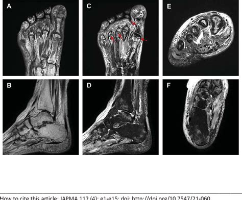 Figure From Multifocal Osteonecrosis In The Foot And Ankle After