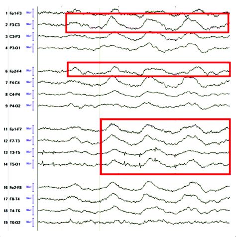 Tracings Showing Abundant Runs Of Slowing Rhythmic Delta Activity With Download Scientific