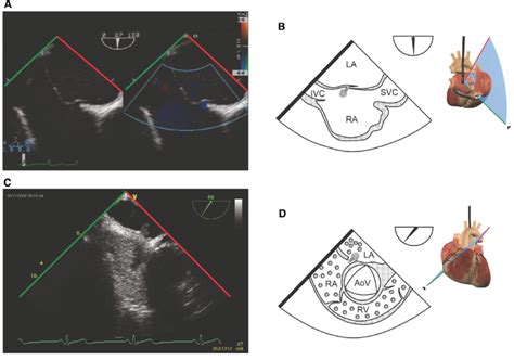 Patent Foramen Ovale Pfo A B A Pfo Is Shown By Colour Doppler