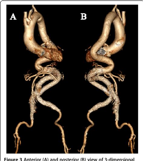 Tortuous Abdominal Aorta