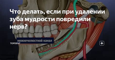 Что делать, если при удалении зуба мудрости повредили нерв? | TopDent ...