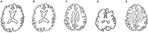 Mri Schemas Of Malformations A Control Brain B Cobblestone