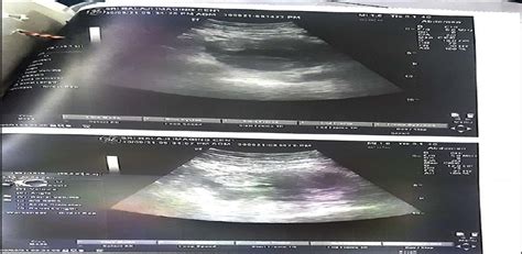 A Rare Case Report Of Bilateral Ruptured Tubal Ectopic Pregn Blde