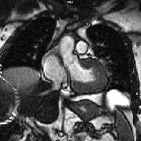 -Confirmation of supravalvular aortic stenosis at angiography ...