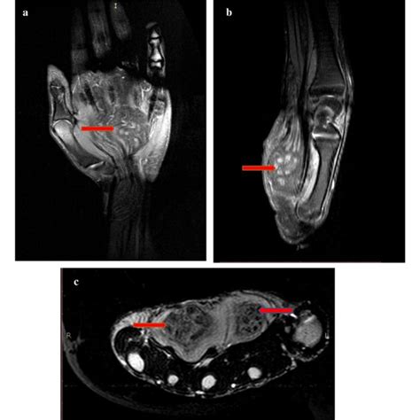 Mri Of The Left Hand A Coronal Section And B Sagittal Section Showing