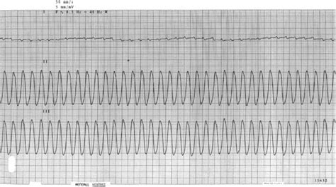 Ventricular Flutter Causes Symptoms Diagnosis And Treatment