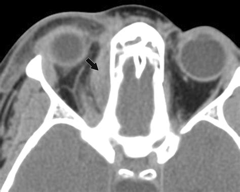 Multiplanar Sinus Ct A Systematic Approach To Imaging Before Functional Endoscopic Sinus