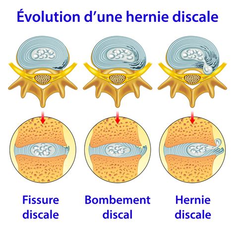 Hernie discale Quoi faire pour soulager la douleur et éviter les