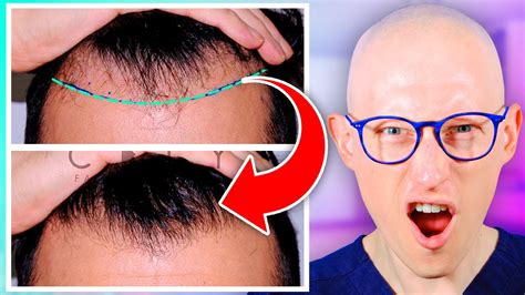 Fix Hair Loss By Implanting New Hair Hair Transplant Youtube