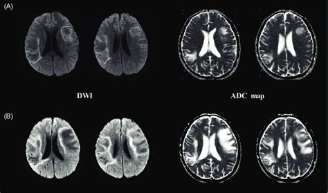 ADC Maps And DWI At The First And Second Examinations A Axial DWI