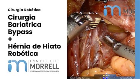 Cirurgia Bariatrica Robótica e Hernia de Hiato Professor Dr Andre