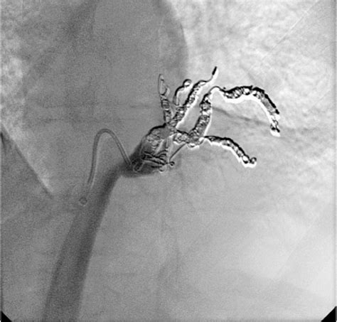 Figure 1 From Embolization Of Symptomatic Intralobar Pulmonary