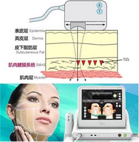 热拉提、热玛吉和超声炮区别，做一次可以维持多久时间 哔哩哔哩