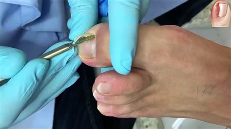 HOW TO CUT THICK TOENAILS Toenail Cleaning Satisfying 7 Video