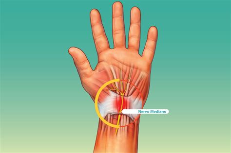 Sindrome Del Tunnel Carpale Dott Mario Menna