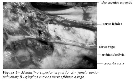 Scielo Brasil Proposta De Metodização Da Linfadenectomia Mediastinal