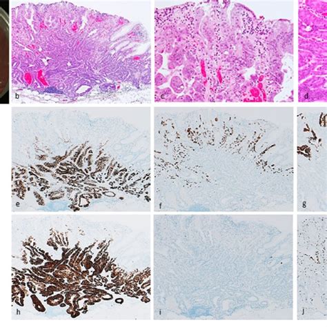 Gastric Adenocarcinoma Of Fundic Gland Mucosa Type Type 1 Organized