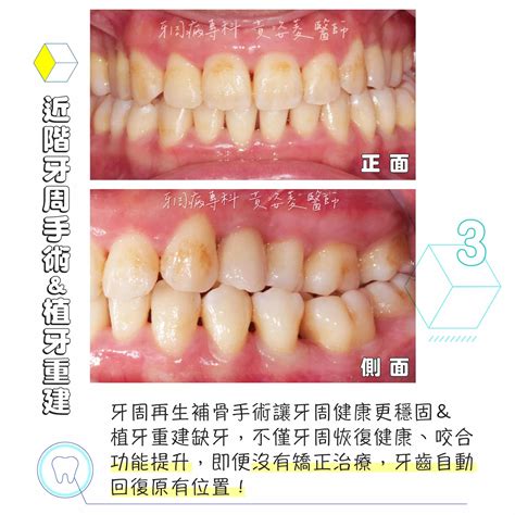 新莊爵美牙醫＆尊爵牙醫官方網站 牙周治療 被牙周病困擾的21歲青春