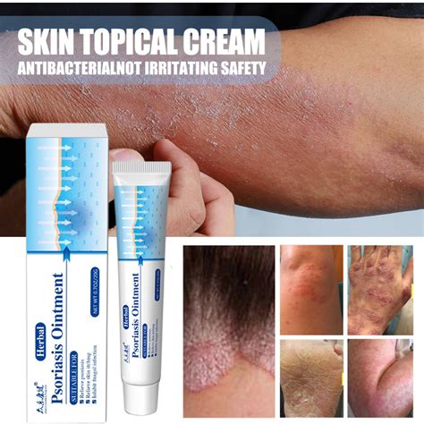 Antibacterial Psoriasis Cream Herbal Treatment Eczema Relief Itch Rash Urticaria Peeling