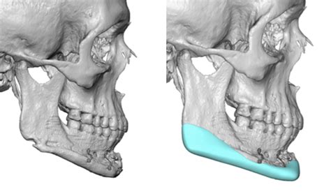 Custom Jaw Implants Chin Implants Eppley Custom Facial Implants