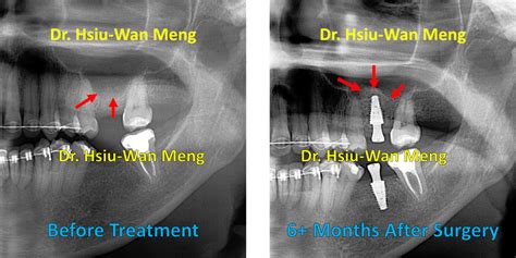 Sinus Bone Grafting Blackhorse Periodontics