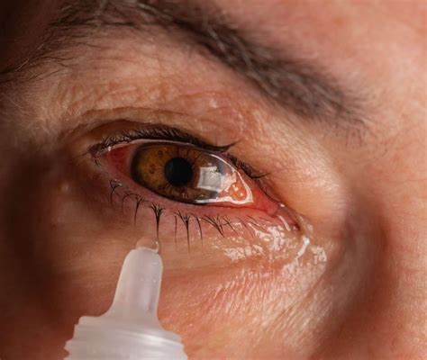Polytrim Eye Drops A Powerful Solution For Eye Infection Treatment