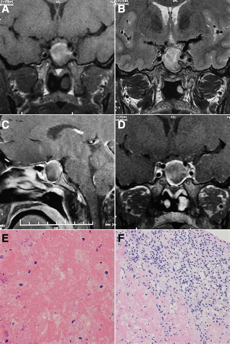 Typical Mri Characteristics Of Pa With Coagulative Necrosis Case 19 Download Scientific