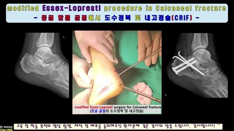 Kang S Surgery Crif Of Calcaneal Fx