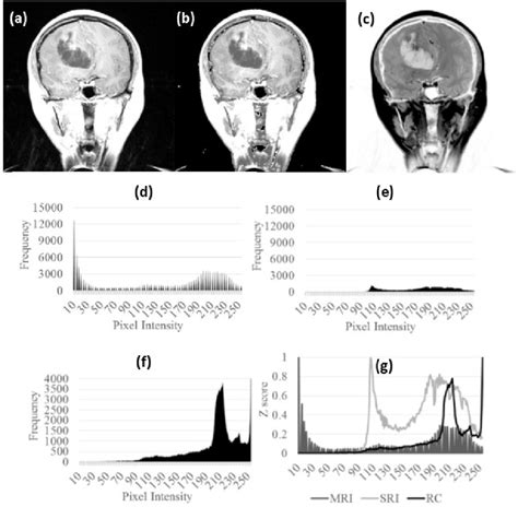 (a) Coronal contrast enhanced T1-weigthed MRI of the anaplastic... | Download Scientific Diagram