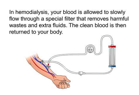 PatEdu Catheter Access For Hemodialysis