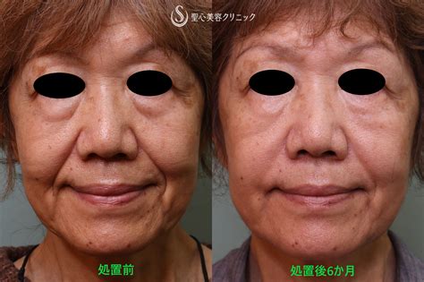 70代、ほうれい線・目の下を同時に治療 美容外科医 佐々木直美blog