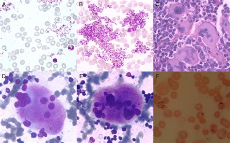 A F A And B Peripheral Blood Smear Leishman 400 Macrocytosis 2