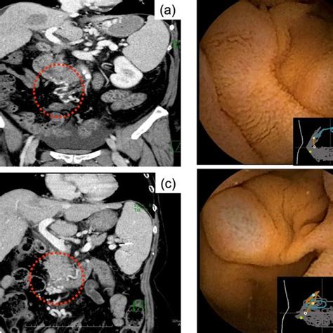 Capsule Endoscopy Of The Small Intestine A Red Spot B Angioectasia C