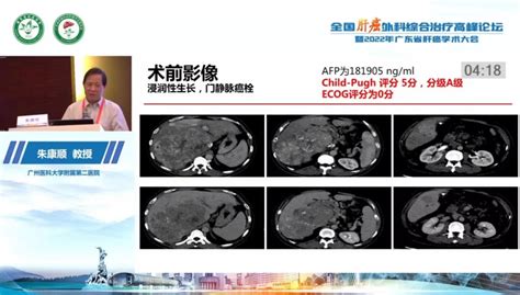 朱康顺教授：肝癌d Tace微球粒径的选择与患者优化门静脉癌栓微球粒径肝癌肿瘤微球栓塞药物 健康界