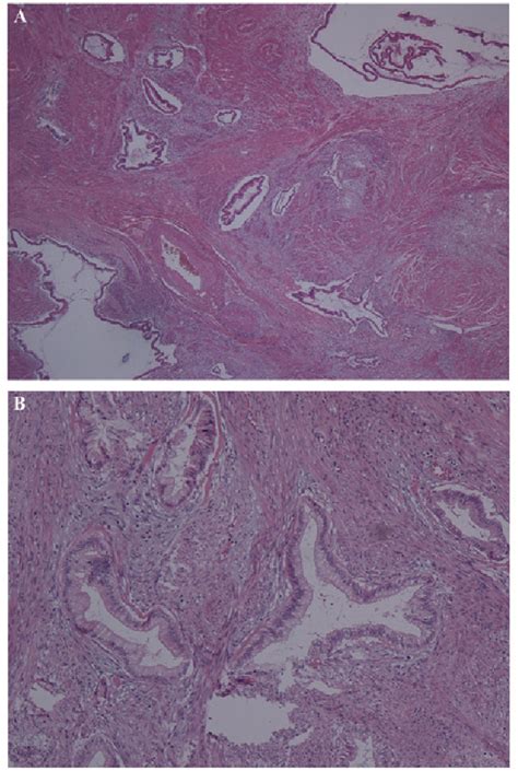 Figure 1 From Minimal Deviation Mucinous Adenocarcinoma Of The Uterine Cervix That Proved