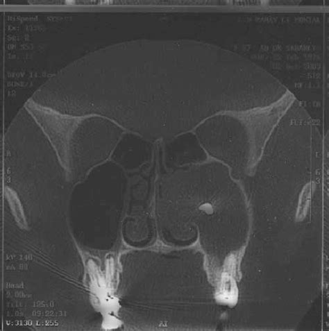 Preoperative Sinus Computed Tomography The Figure Shows A Piece Of