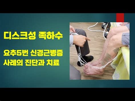 L Radiculopathy Foot Drop Youtube