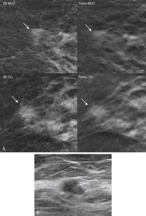 Tomosynthesis In Diagnostic Mammography Clinical Tree