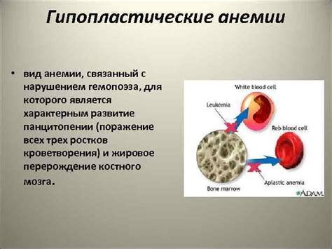 Ведение пациента с анемией Гемолитическая гипопластическая и ...