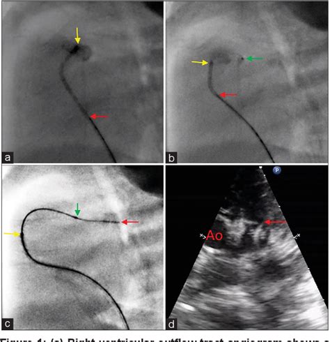 Figure 1 From Central Perforation Of Atretic Pulmonary Valve Using