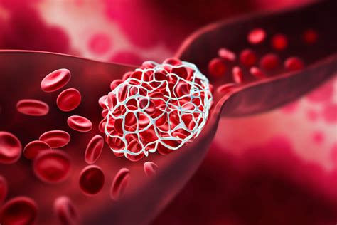 Trombose Classifica Es E Diagn Stico Seegene Brazil