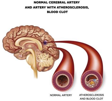 ACV isquémico o infarto cerebral MediciNotas