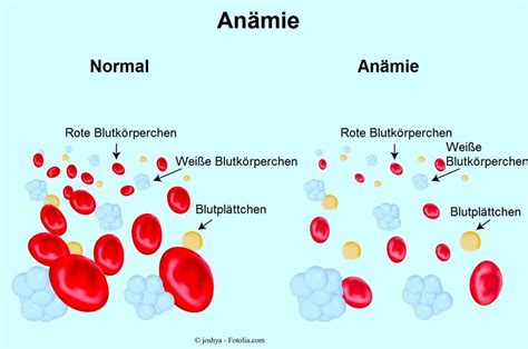 Eisenmangelanämie Symptome Mangel niedrig Eisenmangel hoch Behandlung