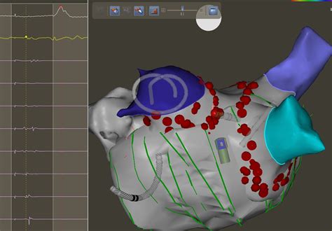 Af Ablation 301 A Quest For Clarity